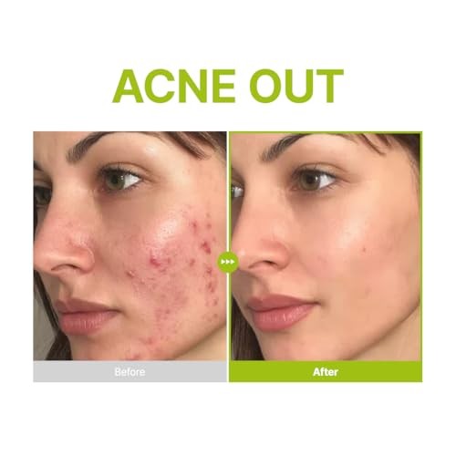 PURITO AZELAIC ACID 10 KOJIC TEA TEA SERUM 30ml